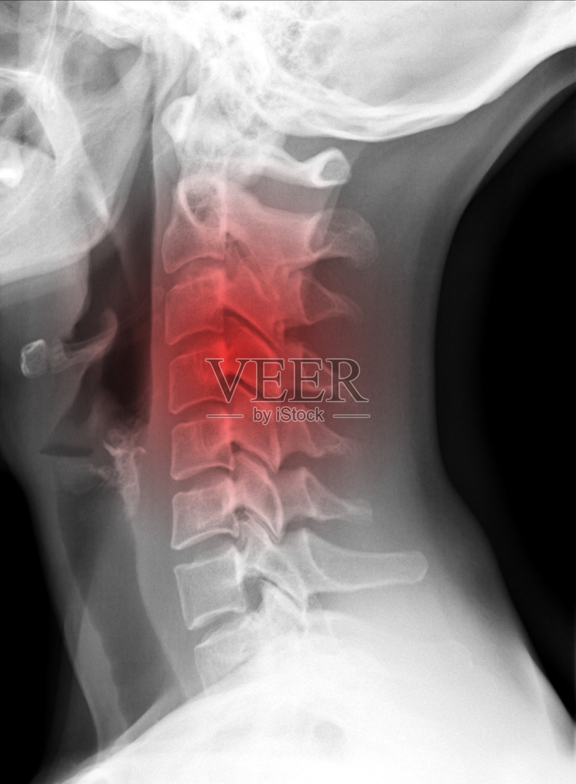 x光片-颈椎，红色表示疼痛部位照片摄影图片
