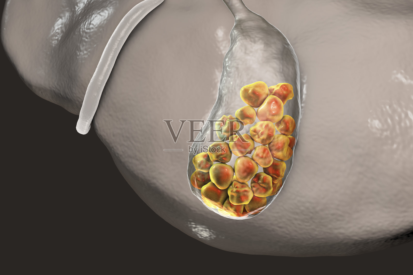 胆结石，图示为伴有结石的肝脏和胆囊的下视图照片摄影图片