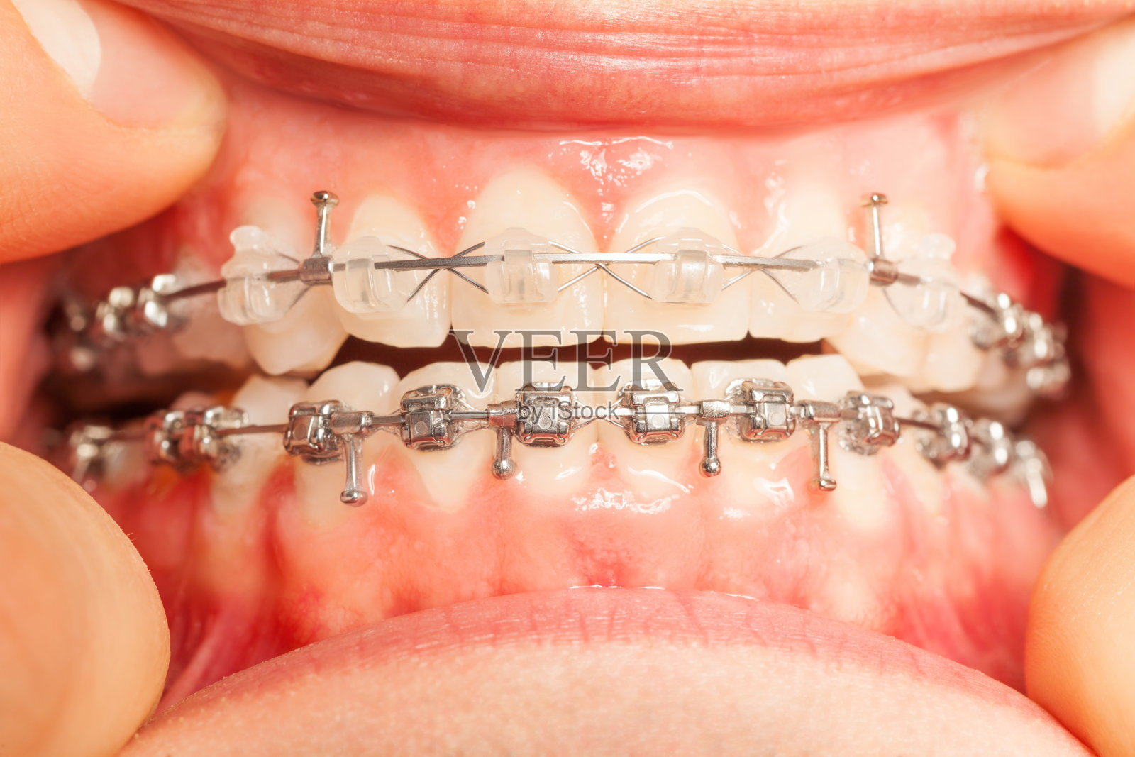 颌与支架安装在牙齿的特写视图照片摄影图片