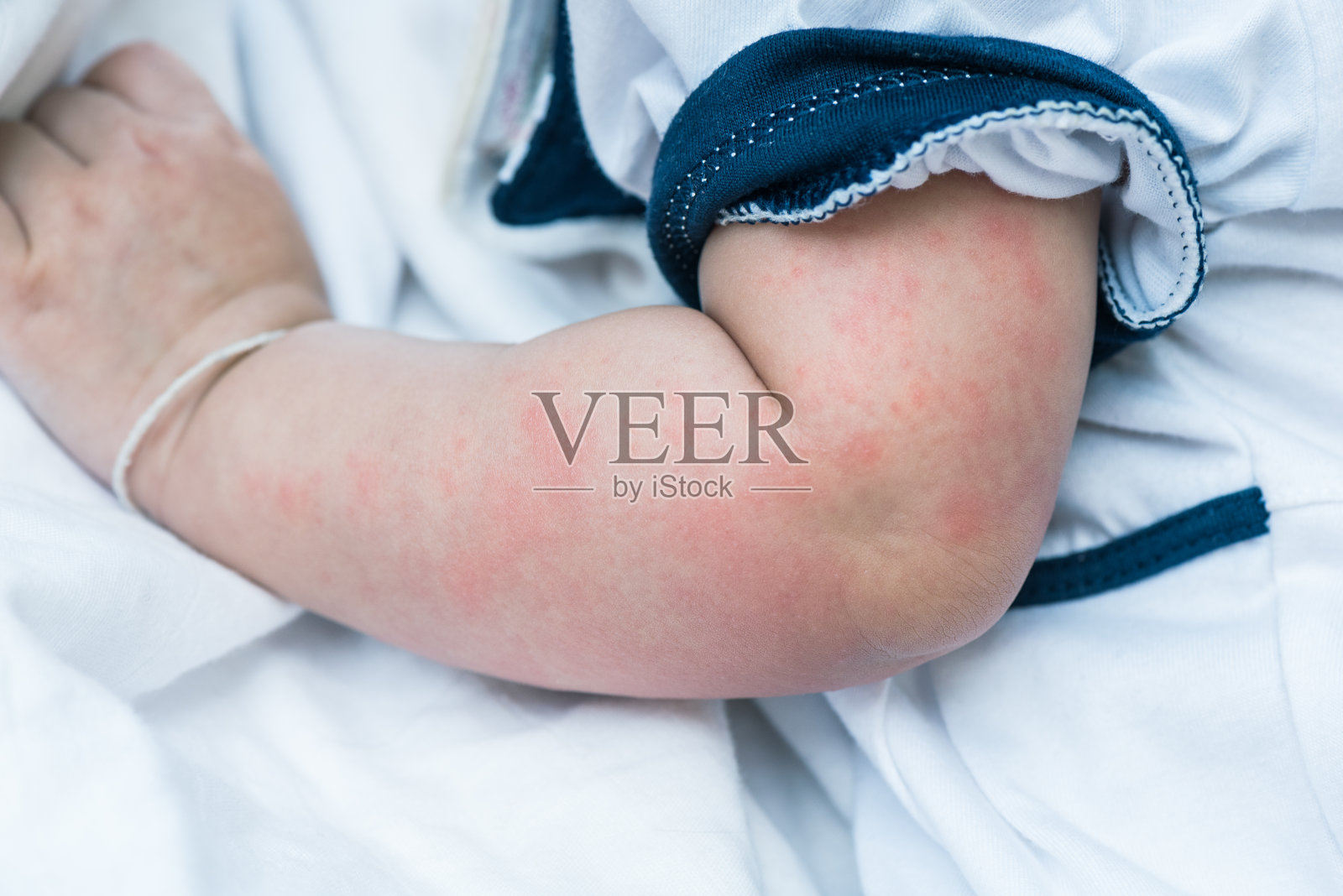 婴儿皮肤质地患严重荨麻疹、荨麻疹。照片摄影图片