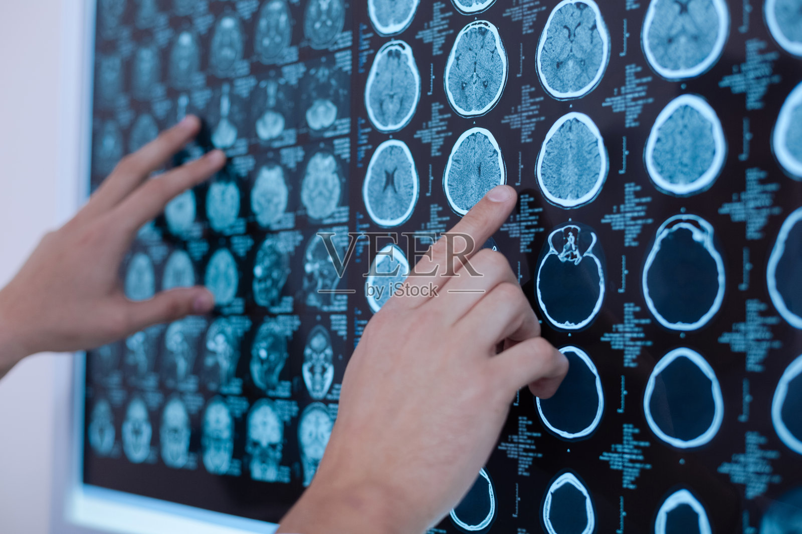 人类大脑的X光图像被放在白板上照片摄影图片