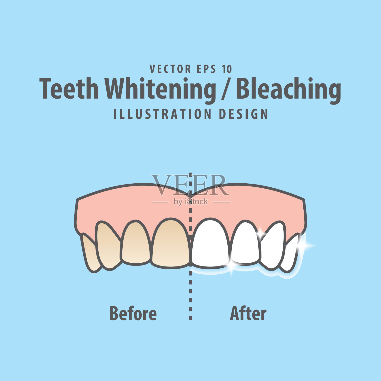 比较上牙漂白-漂白之前和之后的插图矢量在蓝色背景。牙科的概念。插画图片素材
