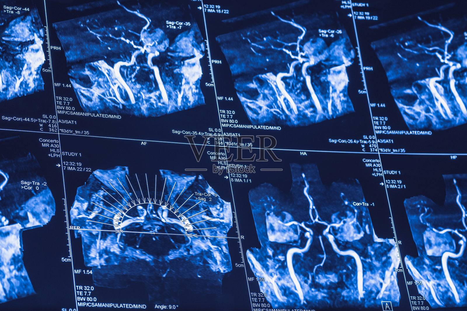 脑血管MRI扫描，椎内动脉、颈动脉投影及其分支的x线断层扫描照片摄影图片