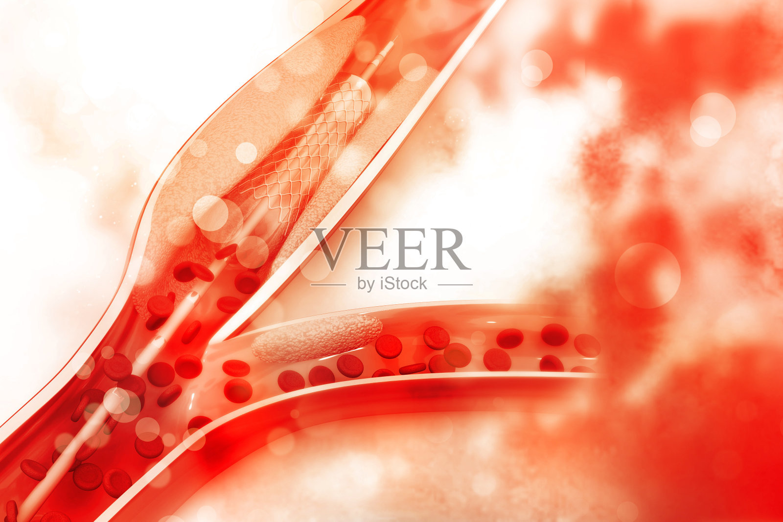 植入球囊的支架血管成形术照片摄影图片