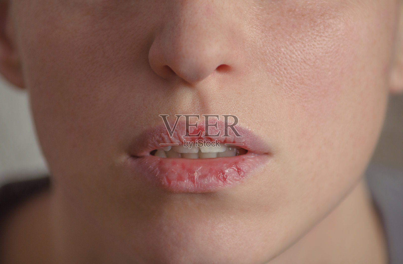 Dermatillomania皮肤挑选。女人有舔嘴唇的坏习惯。由焦虑、压力和嘴唇干燥导致的有害成瘾。剥皮障碍。生病的、开裂的、受损的组织。照片摄影图片