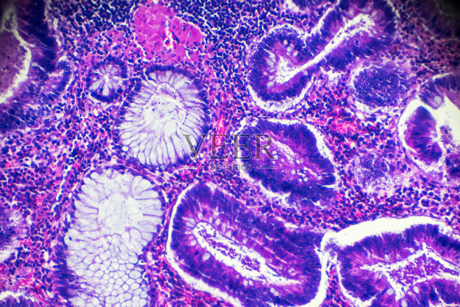 结肠癌显微镜图片图片