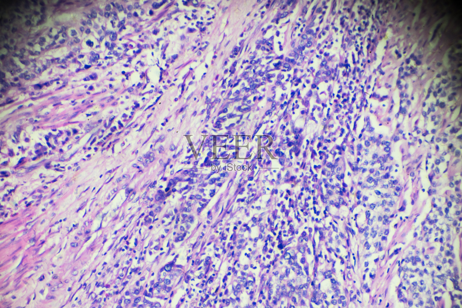 膀胱移行细胞癌的显微镜观察照片摄影图片