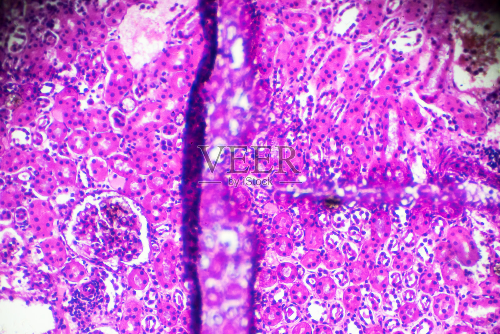 显微镜下急性肾盂肾炎活检标本照片摄影图片