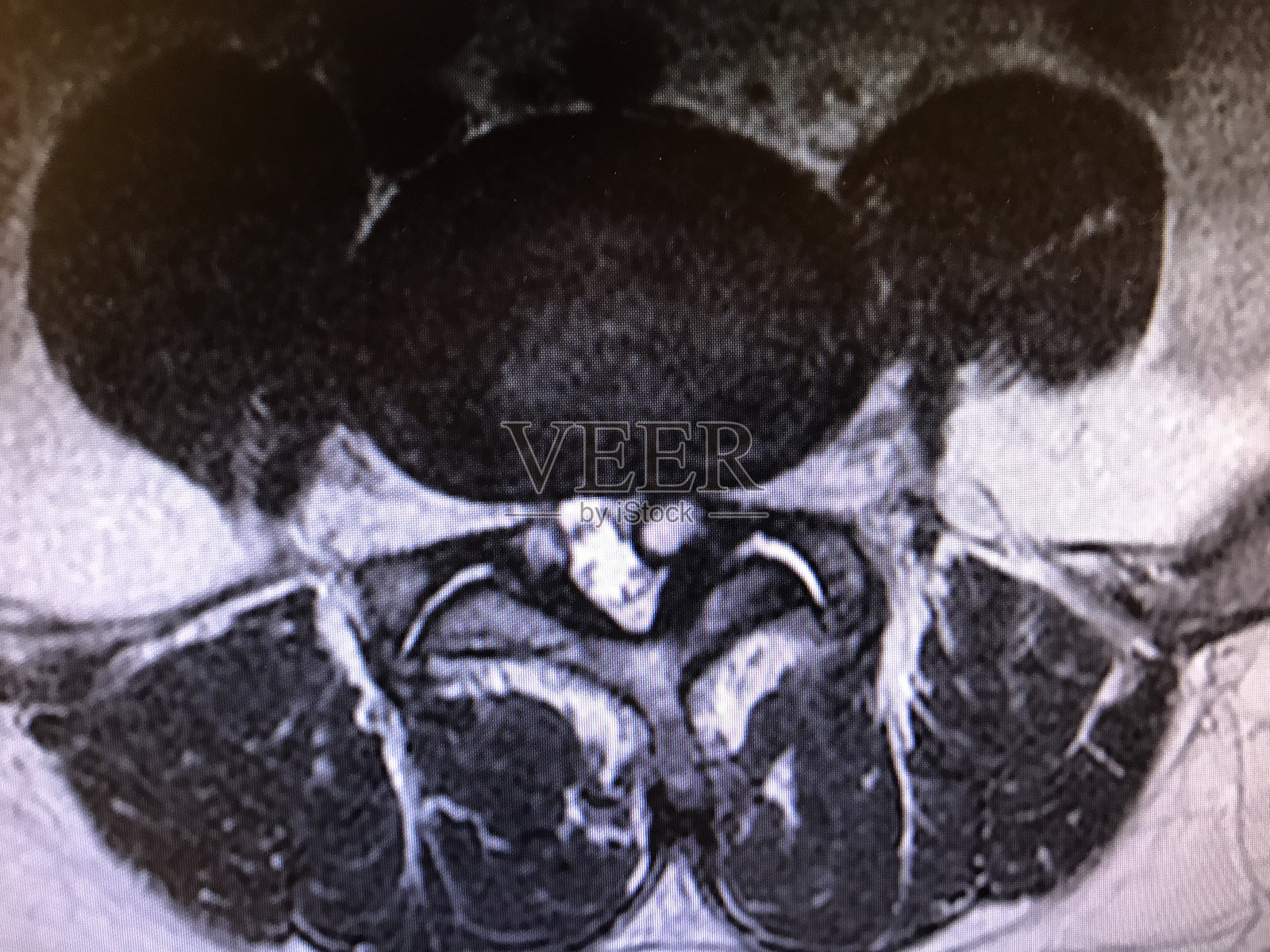 MRI显示腰椎小关节囊肿照片摄影图片