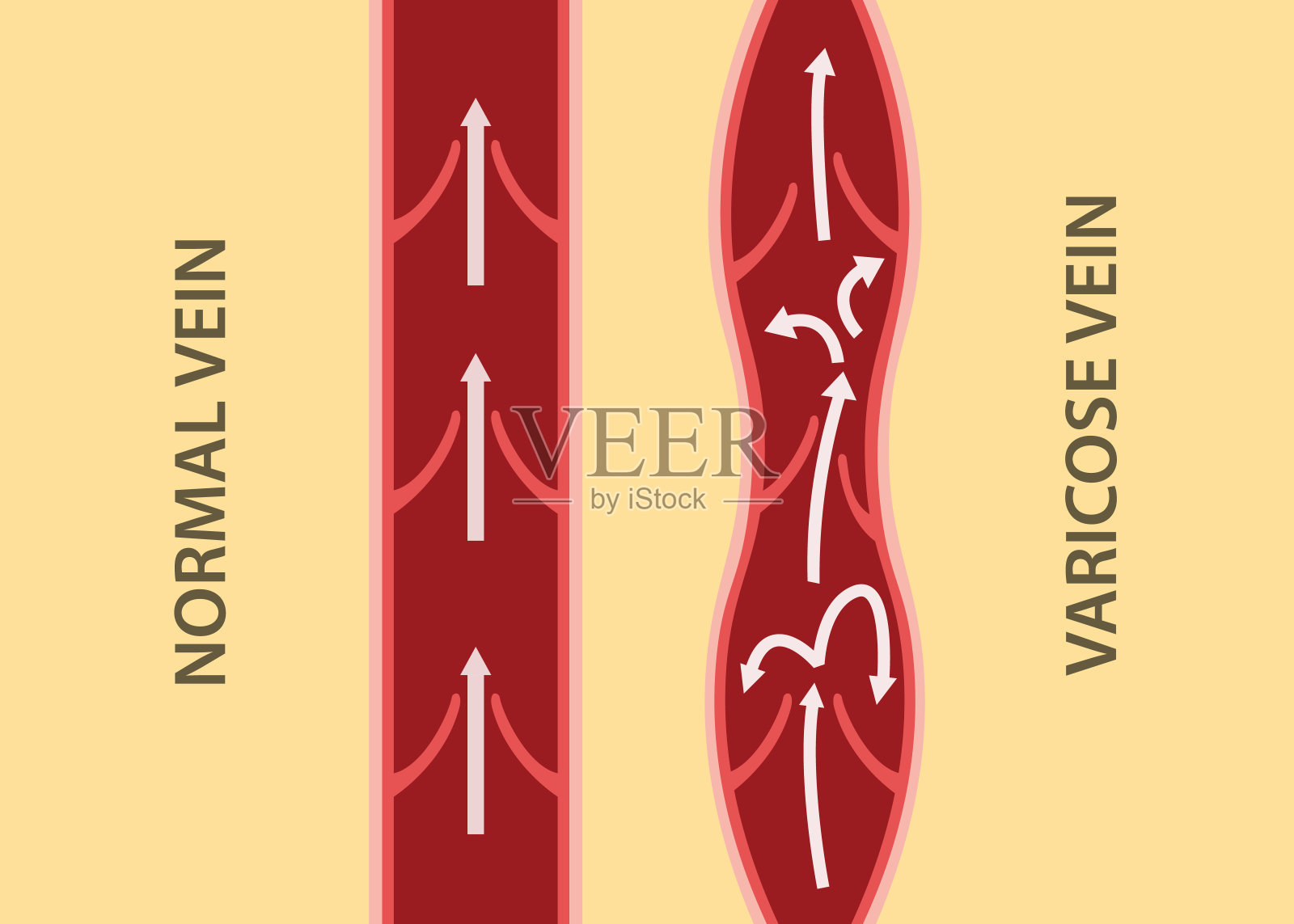 静脉曲张与正常静脉垂直排列的比较插画图片素材