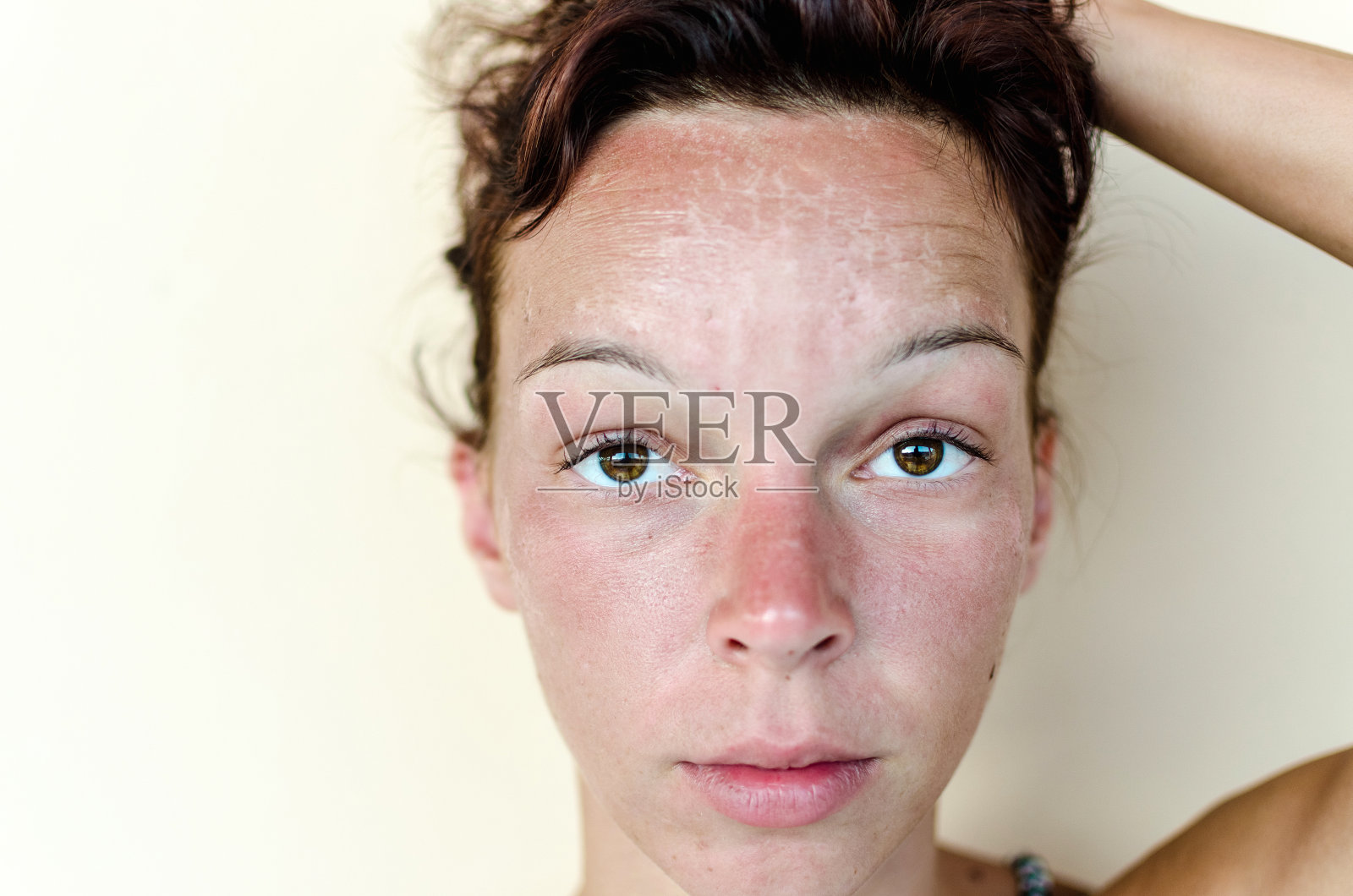 女性面部烧伤照片摄影图片