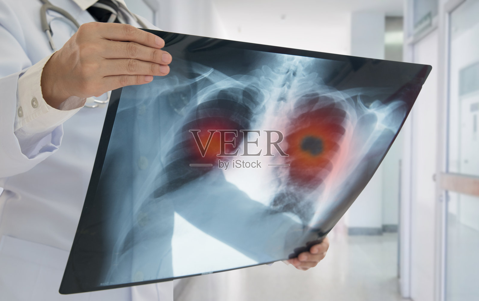 x射线肺癌照片摄影图片