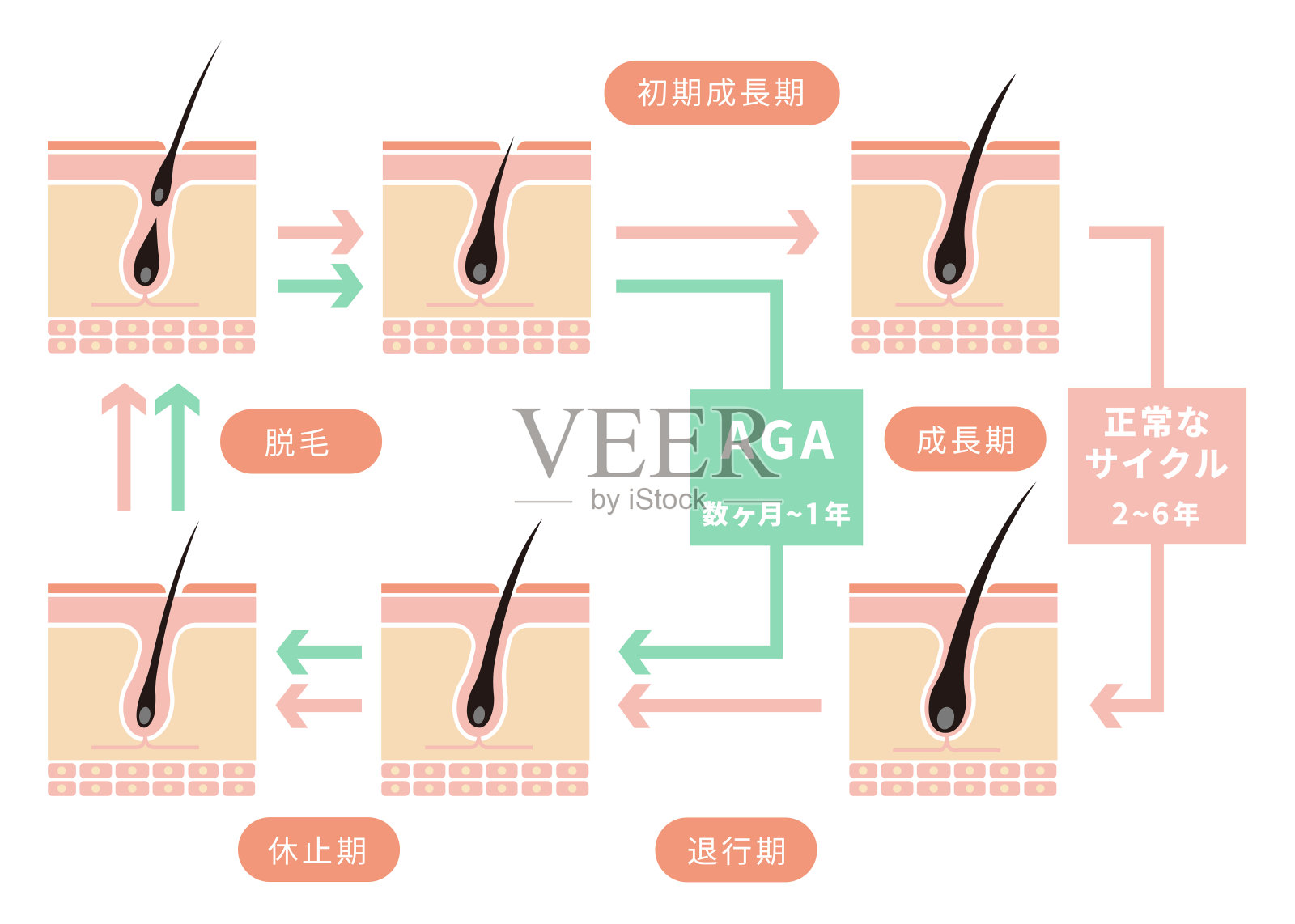 正常头发周期和AGA(雄激素源性脱发)的对比图/日本插画图片素材