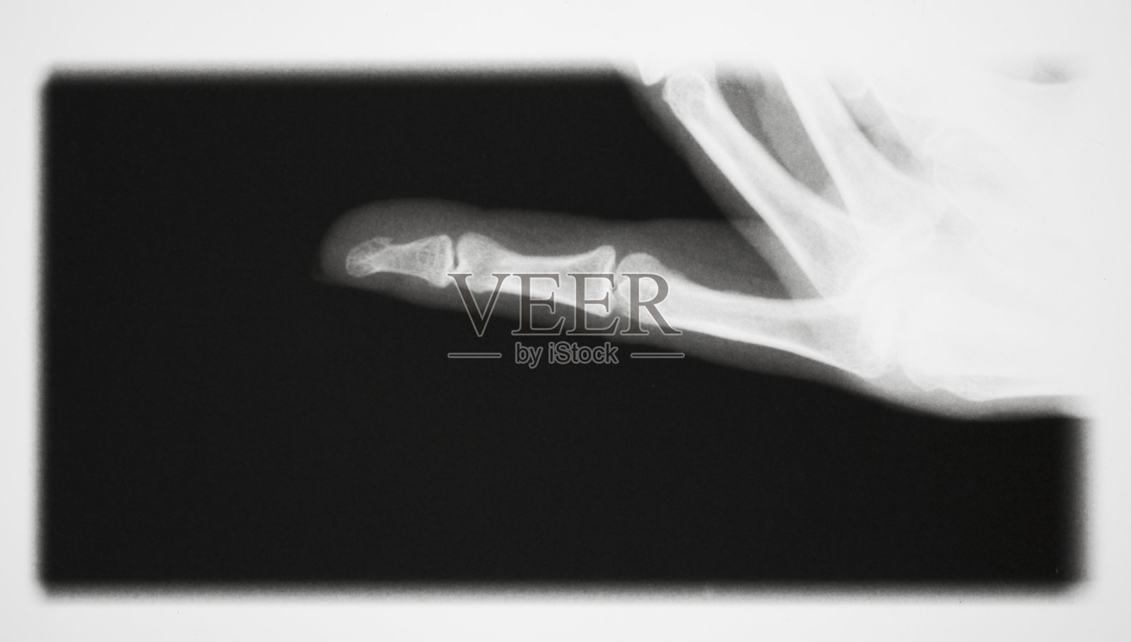 X线照片，女性指尖骨折照片摄影图片
