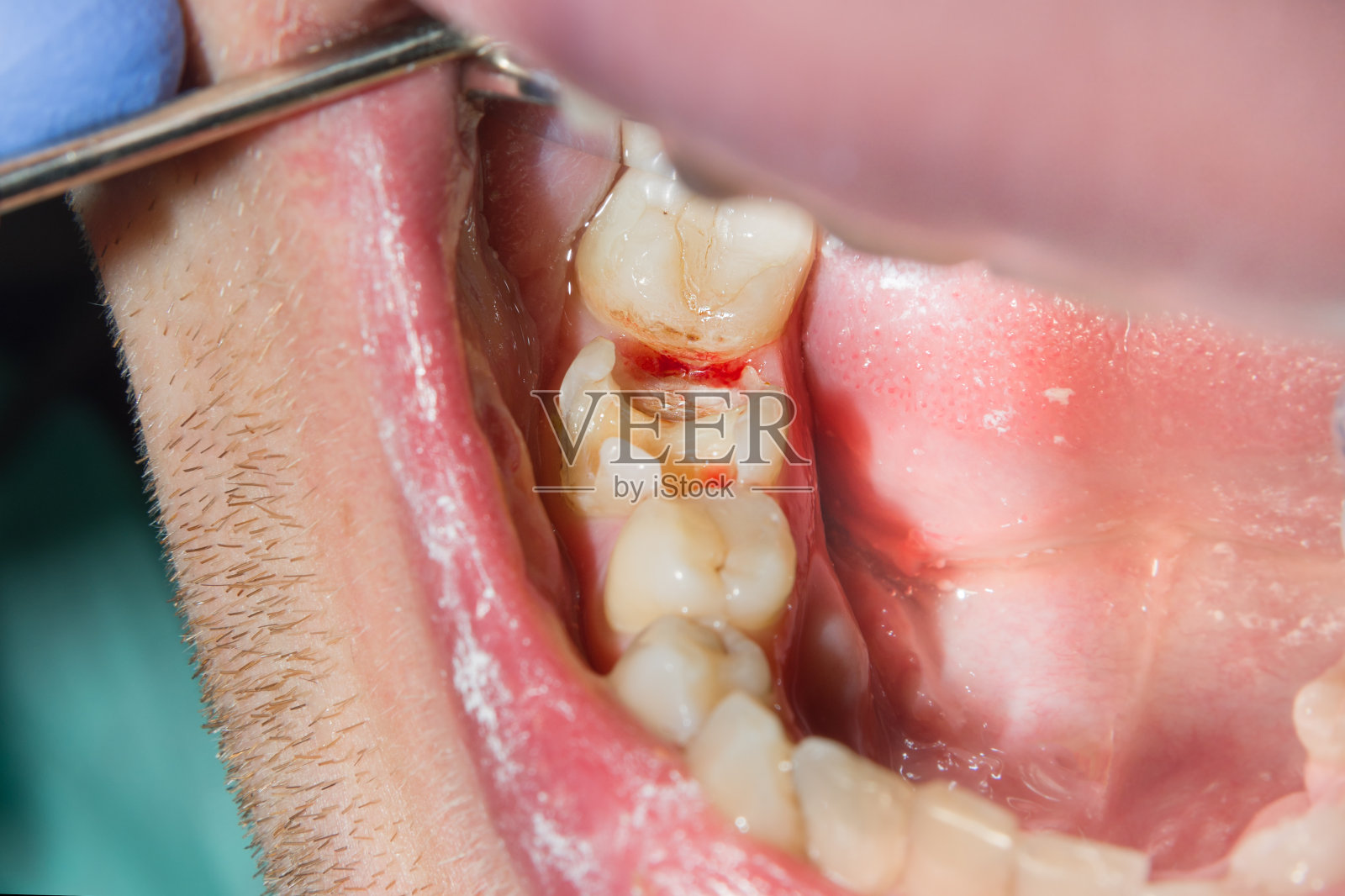 牙科诊所的牙科治疗。蛀牙宏。治疗牙髓学的运河照片摄影图片