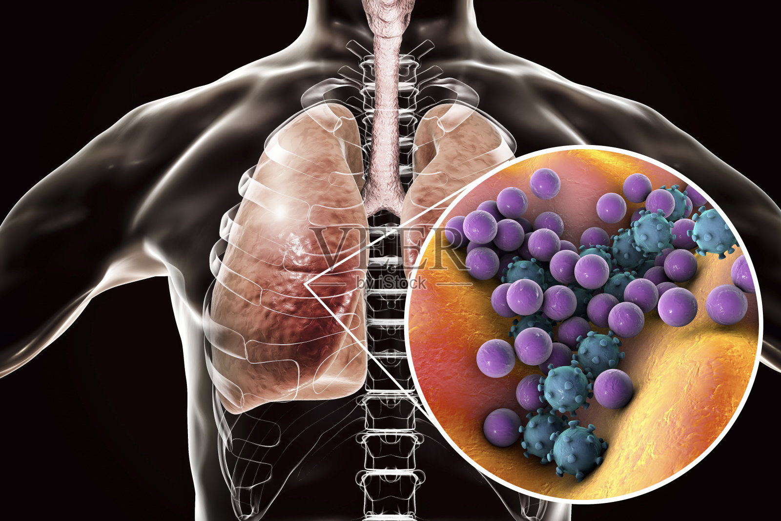 肺炎，医学概念，展示人类肺部的插图和肺部微生物的近景照片摄影图片