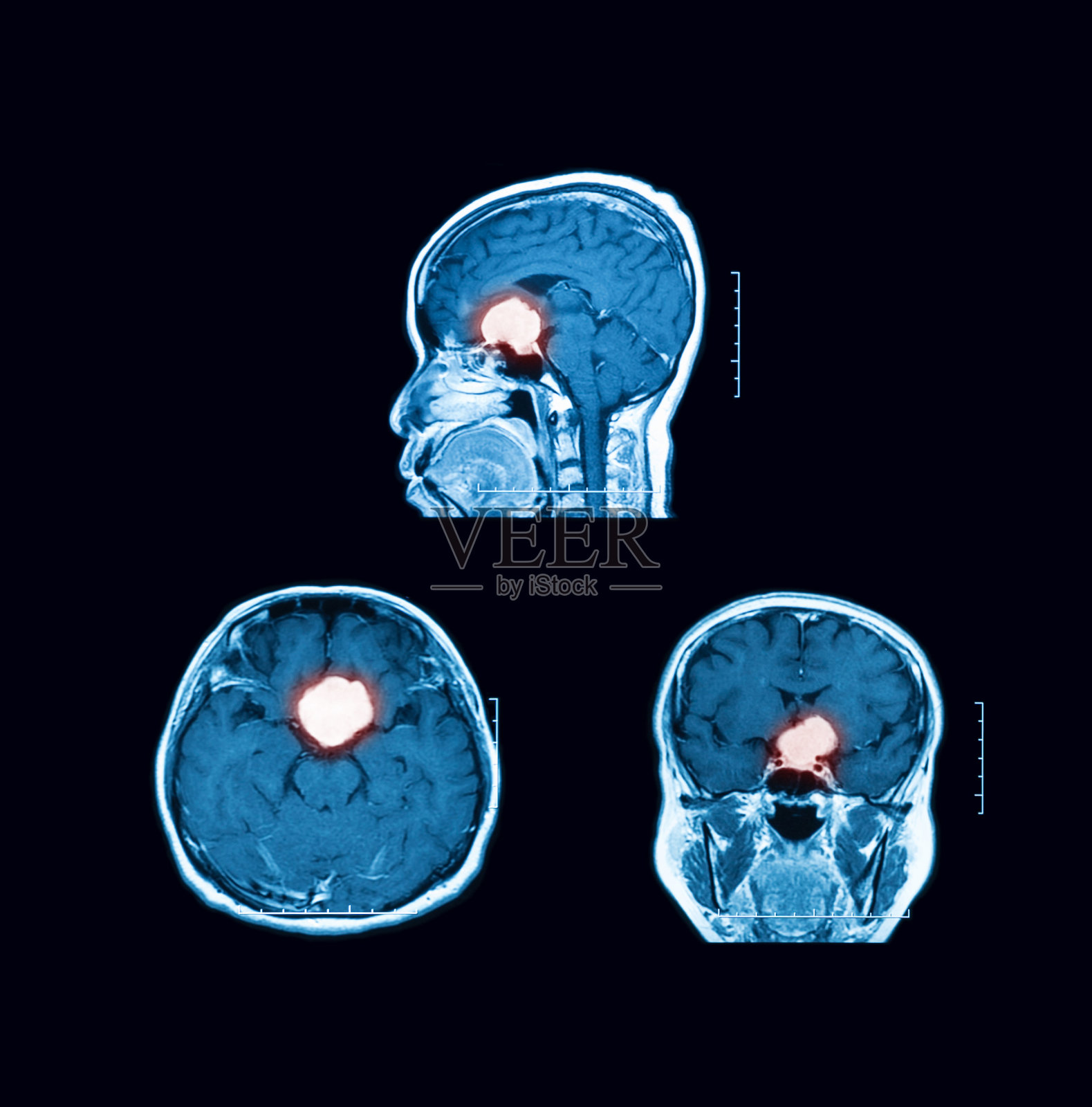 磁共振成像(MRI)与脑部扫描对比。矢状面、横切面和冠状面照片摄影图片
