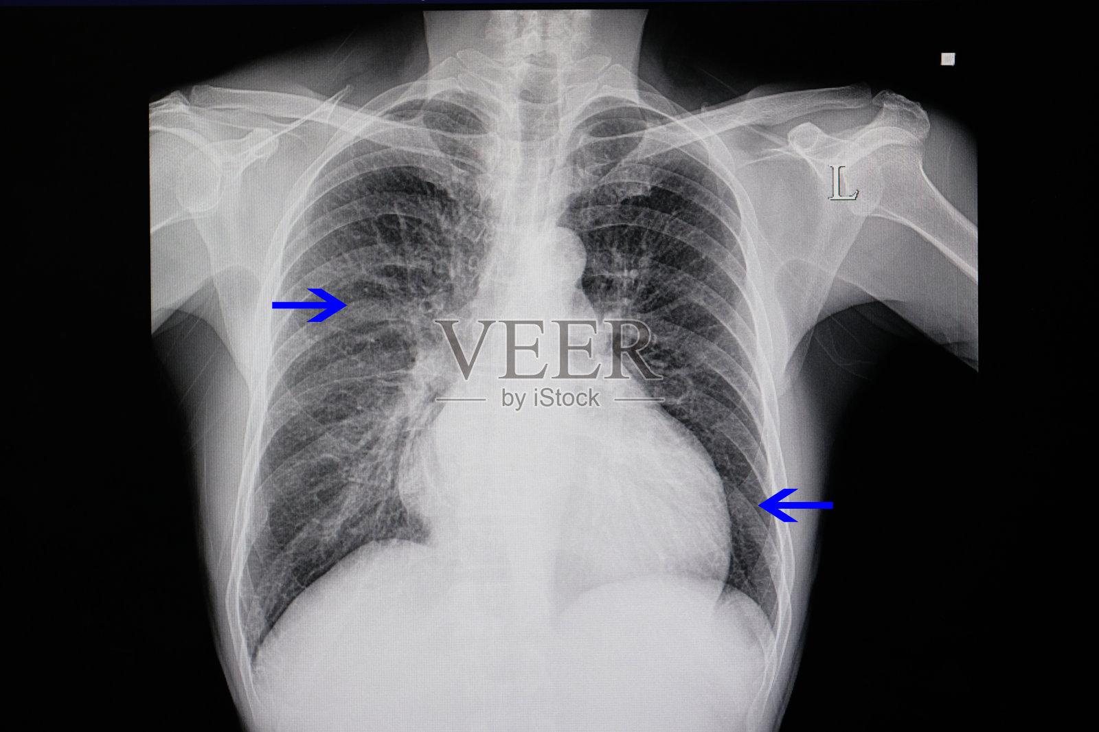 心力衰竭病人的胸部x光片照片摄影图片