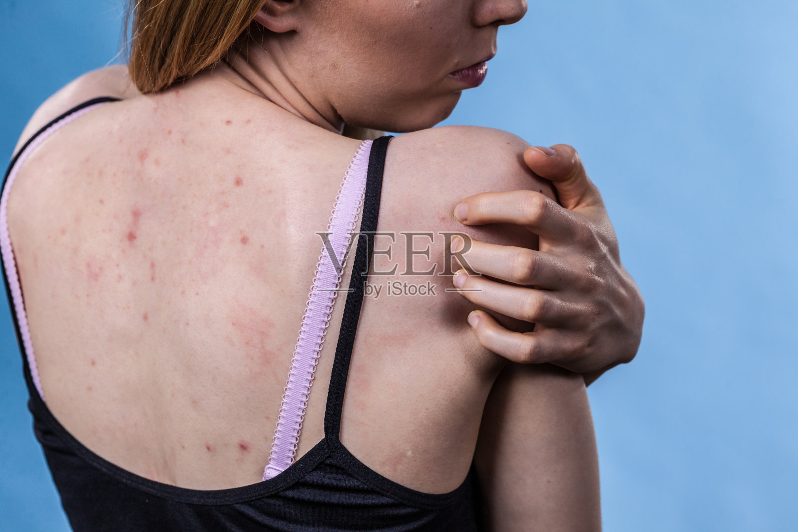 有皮肤问题的女人背部痤疮照片摄影图片