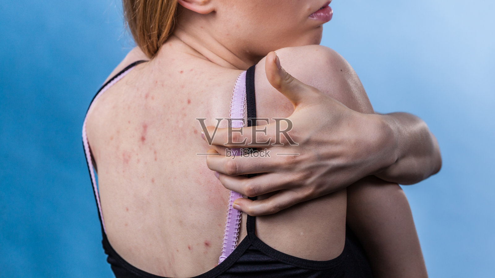 有皮肤问题的女人背部痤疮照片摄影图片