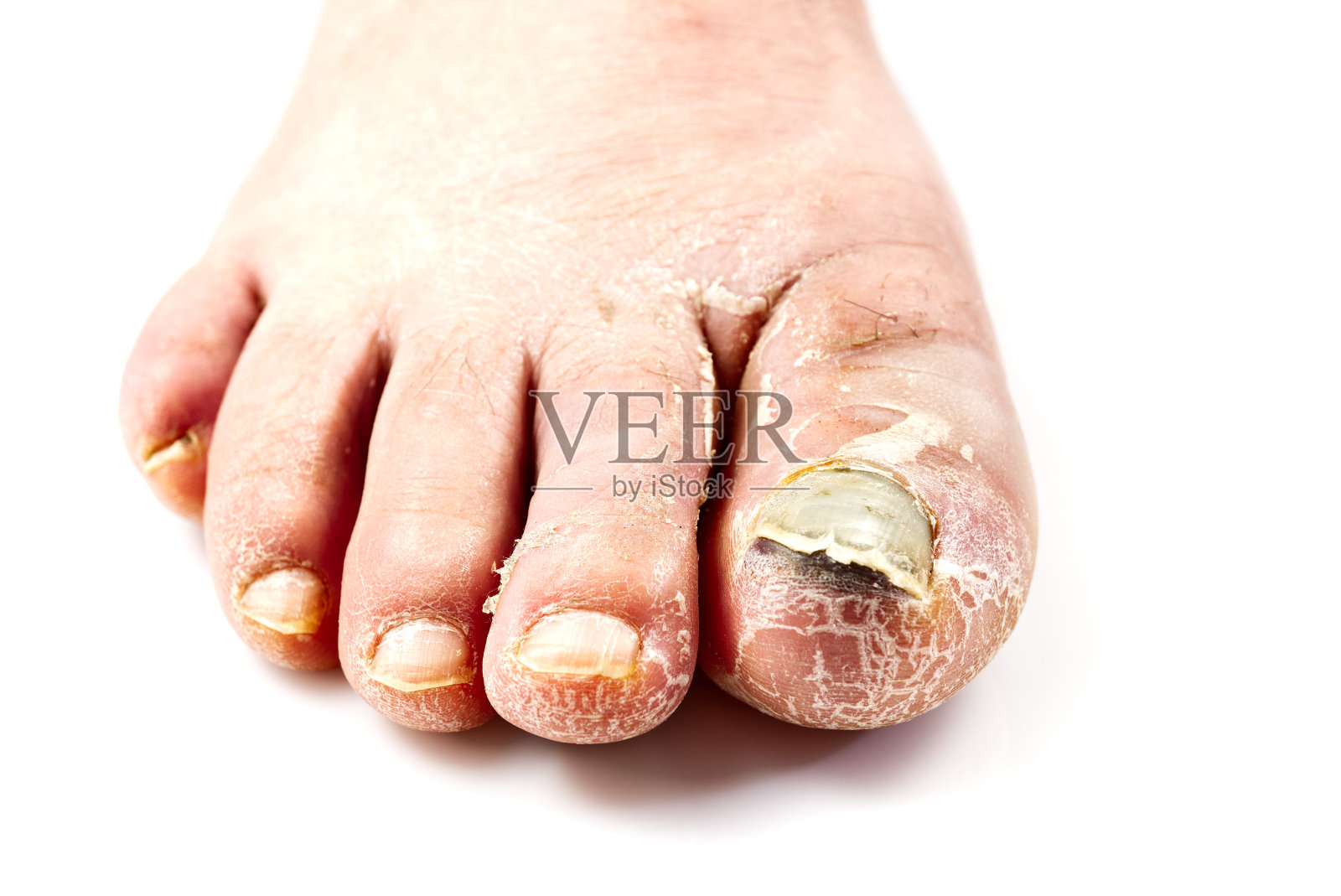 脚上有病的指甲。白色上分离的趾甲真菌。脚趾甲痛，指甲真菌近照照片摄影图片