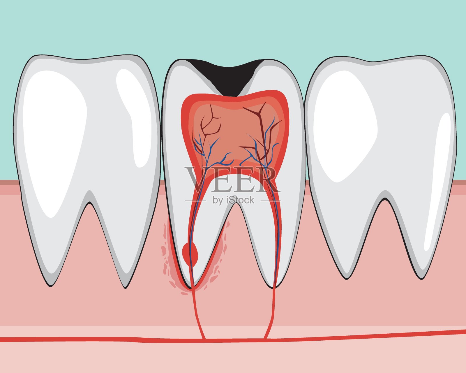 牙髓疾病的治疗 - 口腔医学 - 天山医学院