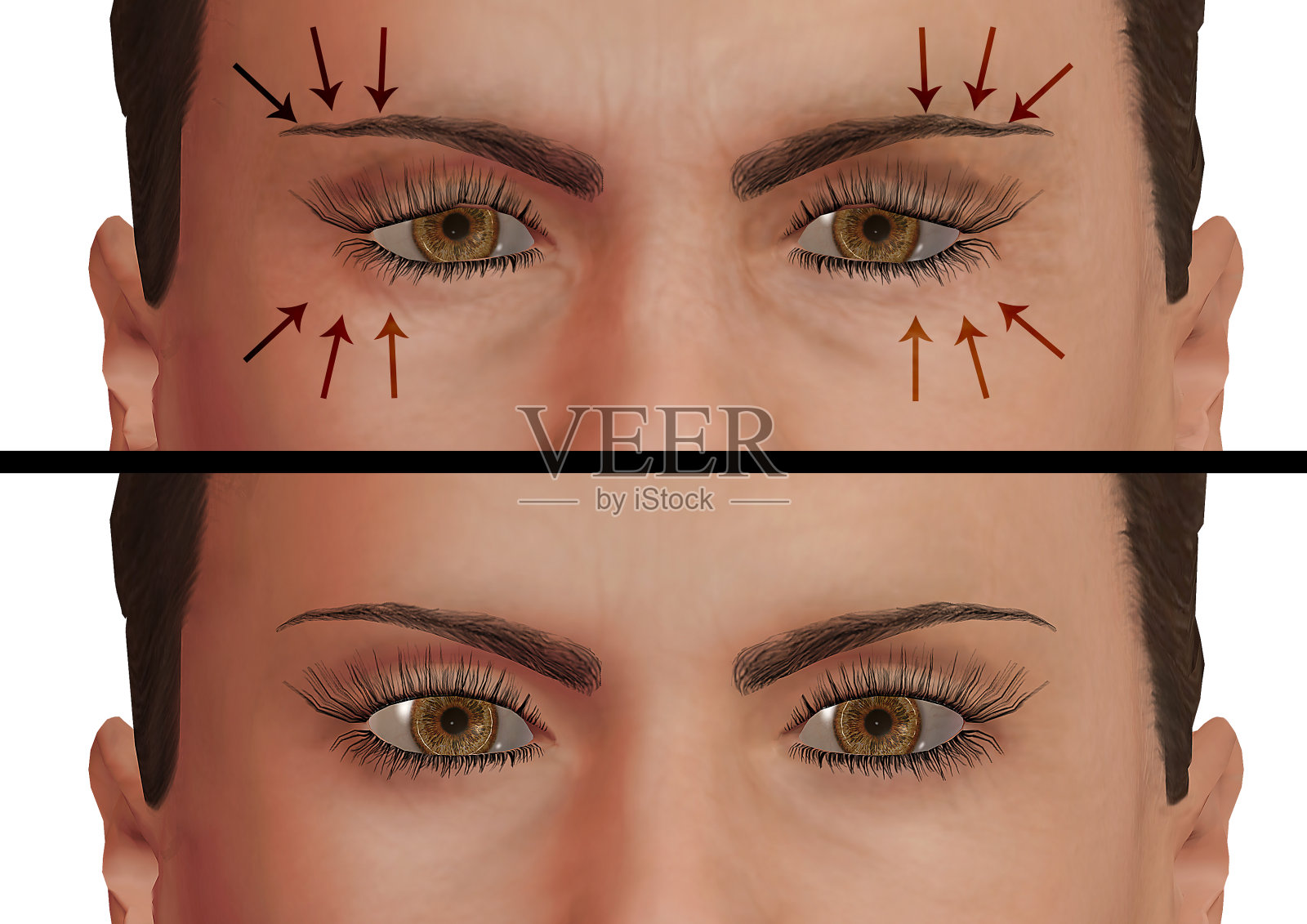 眼睑成形术是一种去除上眼睑和/或下眼睑皱纹和松弛皮肤的整容手术。照片摄影图片