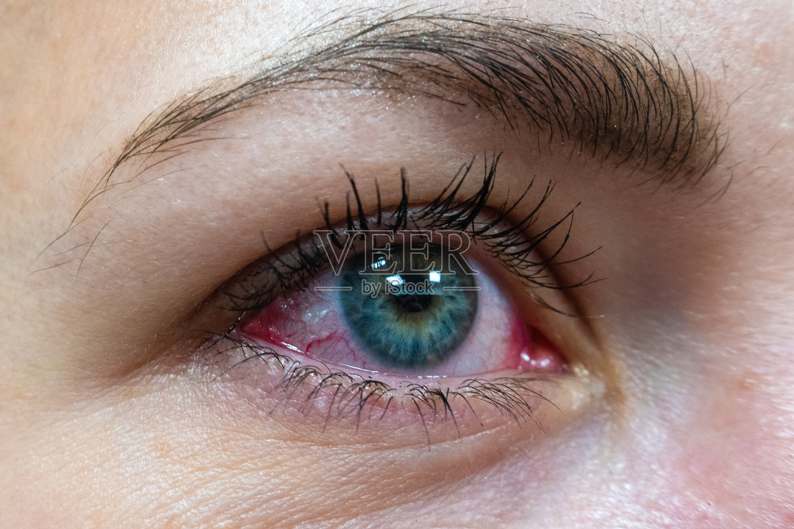 一只女性眼睛因变应性结膜炎而出现红色蛋白照片摄影图片
