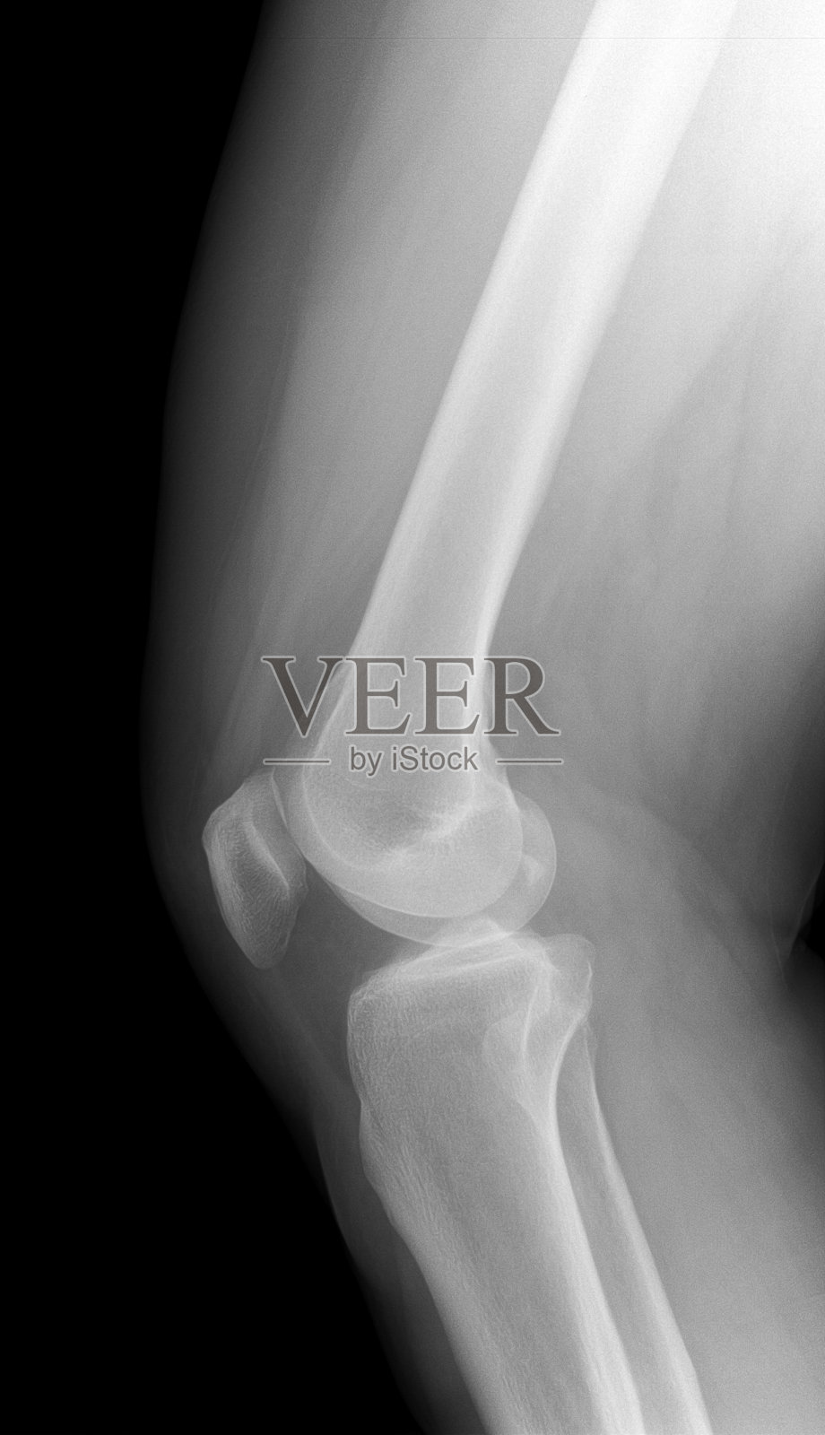 膝关节x光图像。影像学检查膝关节骨关节炎照片摄影图片