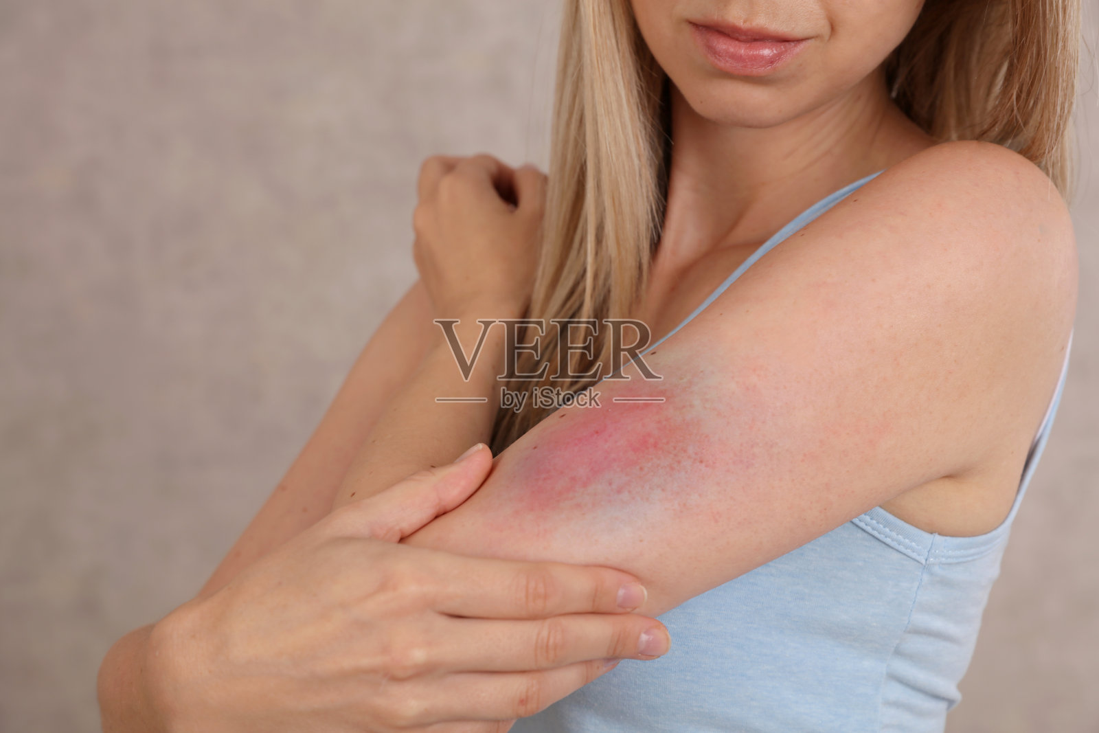 手臂上有大瘀伤的女人。运动损伤。照片摄影图片