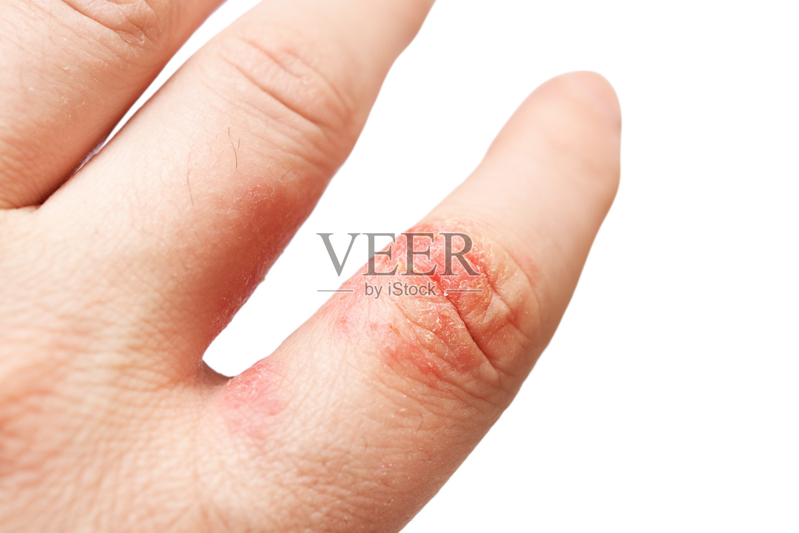 特应性皮炎(AD)，又称特应性湿疹，是一种手指皮肤炎症(皮炎)。照片摄影图片