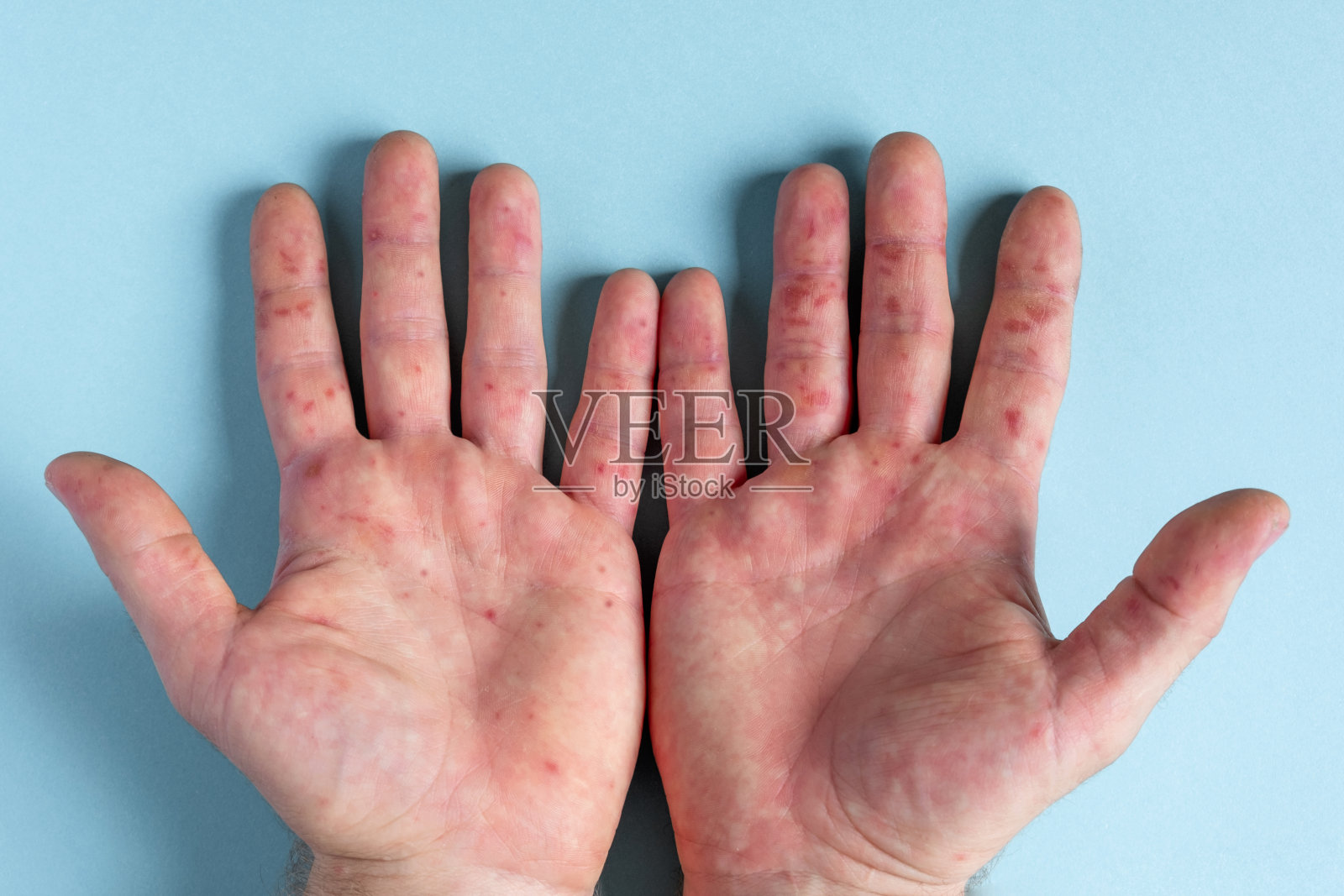 手上有疼痛的皮疹，红点水泡。过敏皮疹，人的手有皮炎和健康问题。病人患湿疹皮肤。病毒性疾病。手掌上有红色皮疹。肠病毒照片摄影图片
